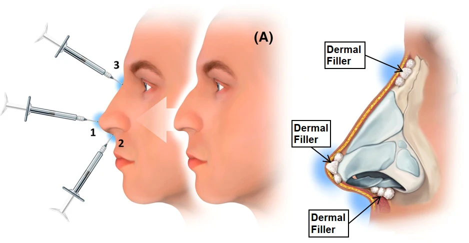How Does Non-Surgical Rhinoplasty Work?